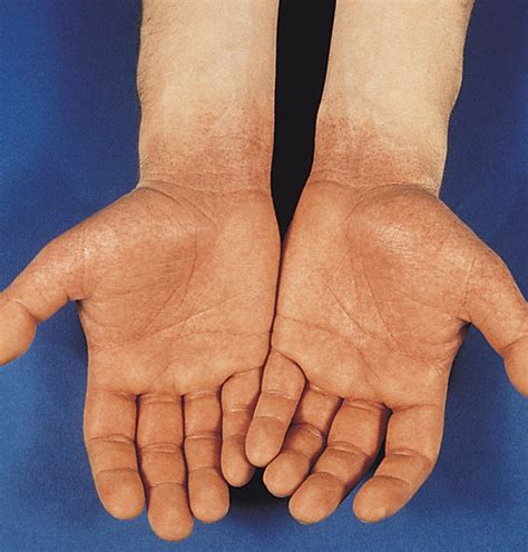 Papular Purpuric ‘gloves And Socks Syndrome Associated With Human
