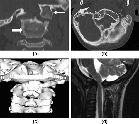 Abnormalities Of The Craniovertebral Junction In The Paediatric