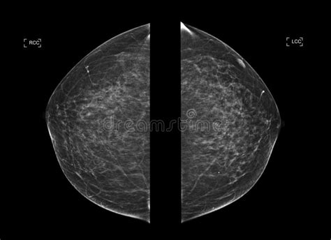 X Ray Digital Mammogram Or Mammography Both Side Of The Breast Cc View