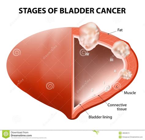 Bladder cancer is caused by cells that mutate (change) and begin to grow in an uncontrolled way. Cancer Bladder Stock Vector - Image: 48558572
