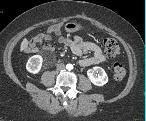 Angiomyolipoma Right Kidney Simualtes A Liposarcoma Near The Right