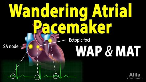 Wandering Pacemaker Litfl Pacemaker Malfunction Litfl Ecg Library
