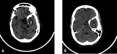 Ct Scan Of Brain Showing Meningioma With Intralesional Calcifications Download Scientific