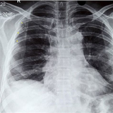 Chest X Ray Showing Ribs Fracture Marked By Asterisks And Surgical
