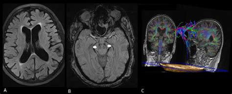 Parkinson's disease is a disorder of the central nervous system (the brain and spinal cord) that affects movement. PDF Brain MRI in Parkinson's disease. | Semantic Scholar