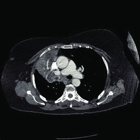 Ct Scan Showing A Right Hilar Mass Which Encases And Narrows The Right