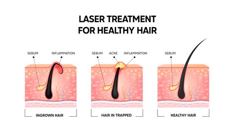 Laser Hair Growth Treatment Everything You Need To Know About It