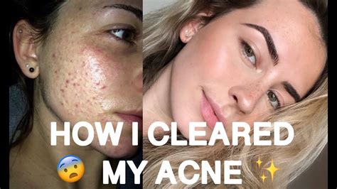 Skincare Routinehow I Cleared My Acne Youtube