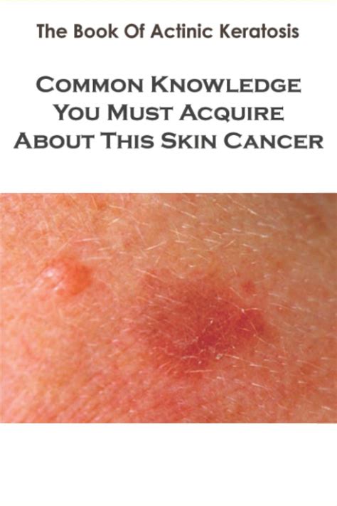 The Book Of Actinic Keratosis Common Knowledge You Must Acquire About