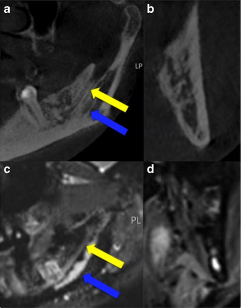 Anatomical Variant With A Doubled Mandibular Canal The Inferior One