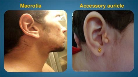 External Ear Disease