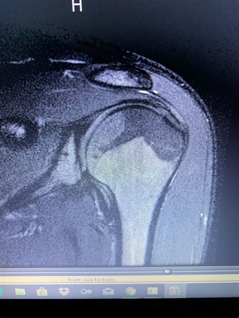 Mri Of Left Shoulder Injury Possibly Rotator Cuff Any Obvious Problems