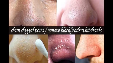 How To Clean Clogged Pores How To Get Rid Of Blackheads And
