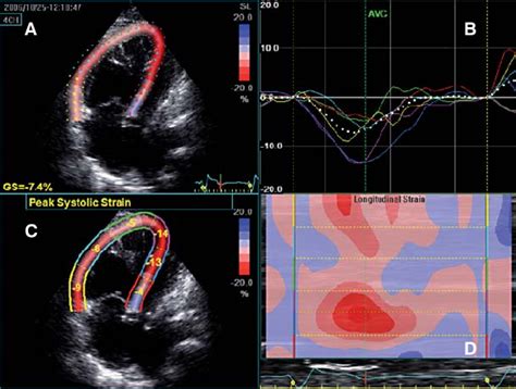 Two Dimensional Strain Imaging Of The Systemic Right Ventricle A A
