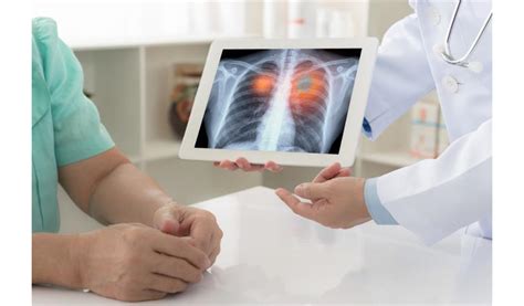 Lung Cancer Screening Signs And Symptoms Lung Cancer Causes