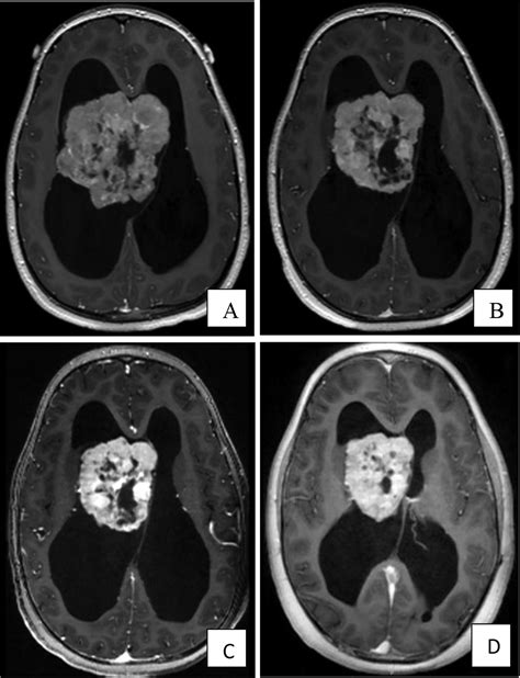 Acute Management Of Symptomatic Subependymal Giant Cell Astrocytoma