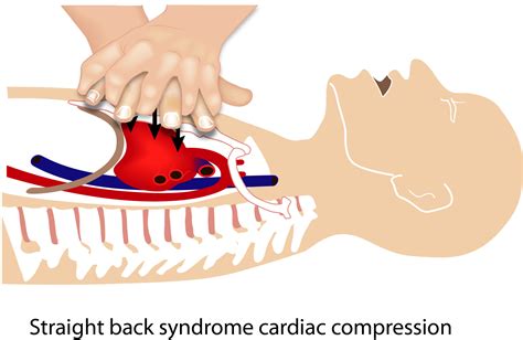 The Mechanism Of Blood Flow During Chest Compressions For Cardiac