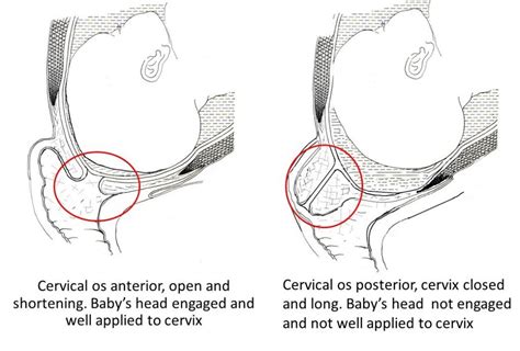 Cervical Stretch And Membrane Sweep Obstetric Excellence