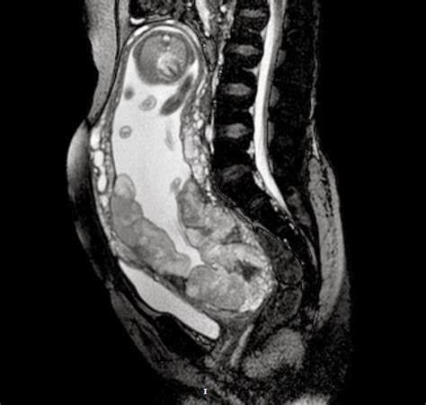 Placenta Increta Mri Sumers Radiology Blog