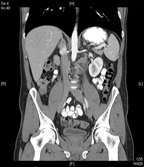 Abdomen Ct Demonstrating Moderate Para Aortic Lymphadenopathy With