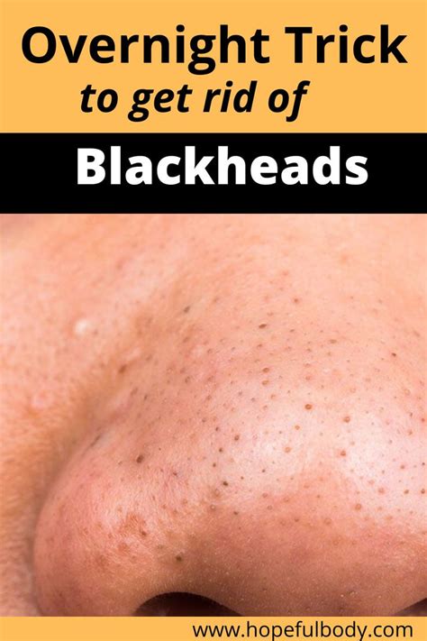 10 Simple And Easy Home Remedies To Get Rid Of Blackheads Get Rid Of