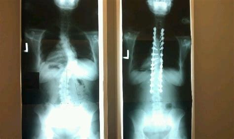 Spinal Fusion Blog About Recovery Spinal Fusion Surgery