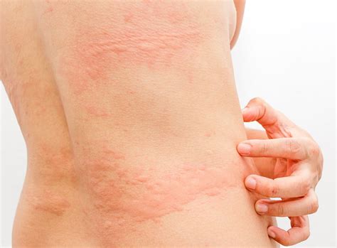 Make An Appointment For Urticaria Treatment Akiya Aesthetics Clinic