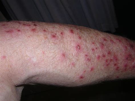 These spots scaly rough patches are troublesome, however, if treated early, you can get rid of them before they develop there is currently no published research to confirm its effects on actinic keratosis but it is among the most popular home remedies used by people. Rick & Cindy Manz: Actinic keratosis