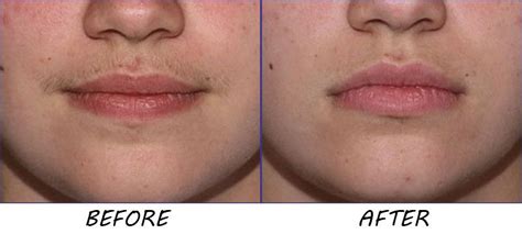 How To Get Rid Of Upper Lip Blackheads Howtormeov