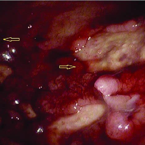 Upper Gastrointestinal Endoscopy Revealing Multiple Deep Ulcers In The Download Scientific