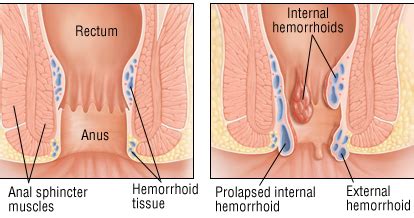Internal hemorrhoids may be uncomfortable but are not as painful. Hemorrhoids - Harvard Health