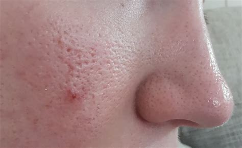 Severely Enlarged Pores General Acne Discussion