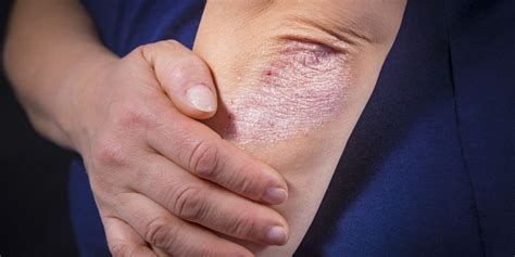 Various Symptoms Of Psoriasis Chronic Disease That Makes Scaly Skin