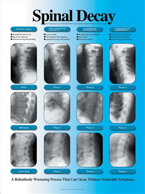 Subluxation Degeneration Chart Chiropractic X Ray Chart