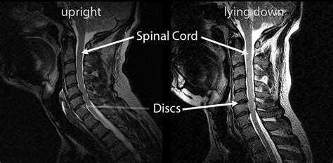 Cervical Spine Mri Comparison
