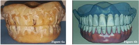 Norlela y1, wn syariza2, faizah a fatah3 1,2, prosthodontic specialist clinic, faculty of dentistry, universiti abstract background: Using a Simple Chair-Side Copy Denture Technique in the ...