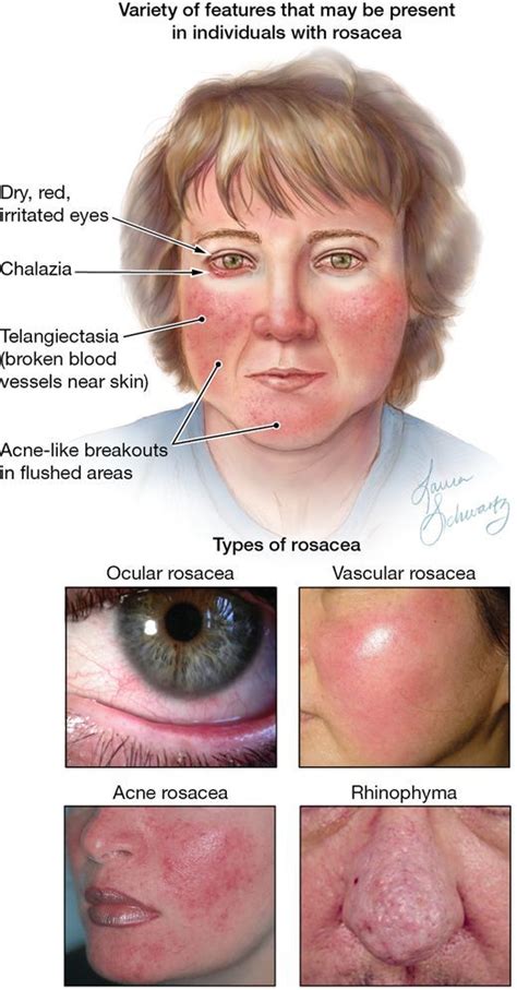 Rosacea Is A Relatively Common Chronic Skin Disorder With Symptoms