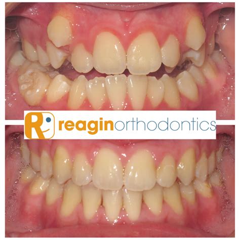 Braces Before And After Reagin Orthodontics Summerville Sc