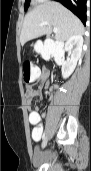 Identifying The Cephalad Portion Of The Appendix In A 14 Year Old Boy