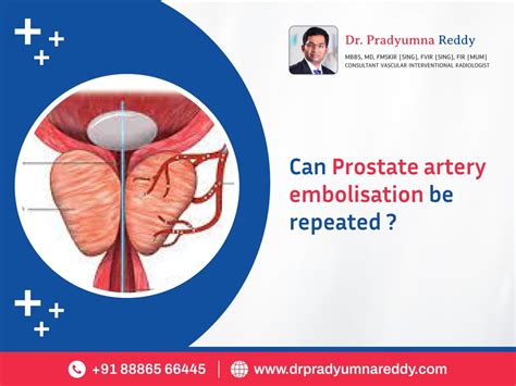 Can Prostate Artery Embolization Be Repeated
