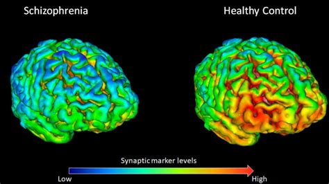 Scientists Find Key Difference In The Brains Of People With Schizophrenia Faculty Of Medicine