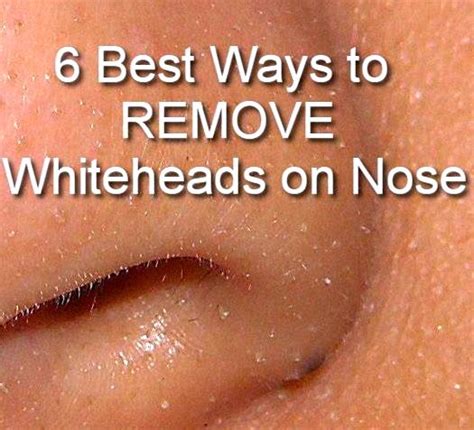 6 Best Ways To Remove Whiteheads On Nose Whiteheads Remedy