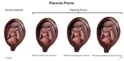 Vasa Previa Vs Placenta Previa Symptoms Management And Treatment