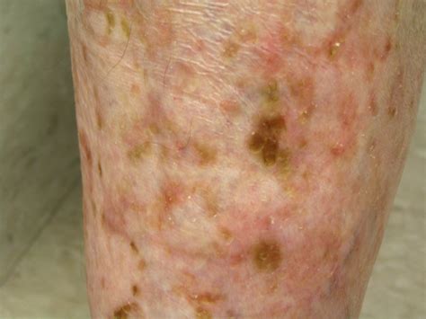 Actinic Keratosis Pictures And Photos