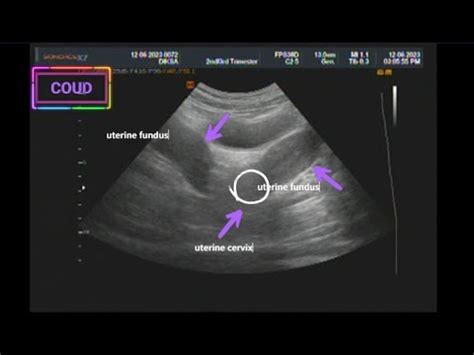 Ultrasound Video Of Didelphys Uterus Youtube