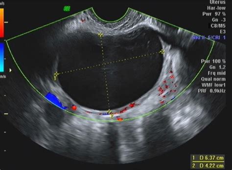 Cysts In Uterus Ultrasound