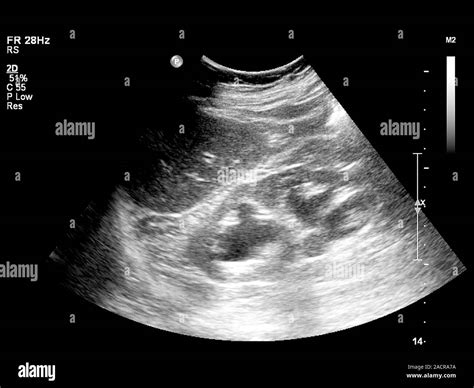 Gallstone Ultrasound Scan Of The Abdomen Of A Patient That Has A