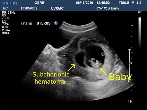 Subchorionic Hemorrhage New Kids Center Obstetric Ultrasound