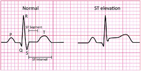 Normal And St Segment Elevation Pattern Of Ecg Signal Download