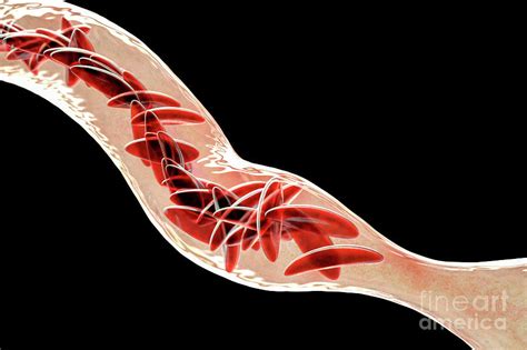 Blood Vessel Blocked In Sickle Cell Anaemia Photograph By Kateryna Kon